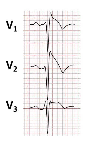 Brugada