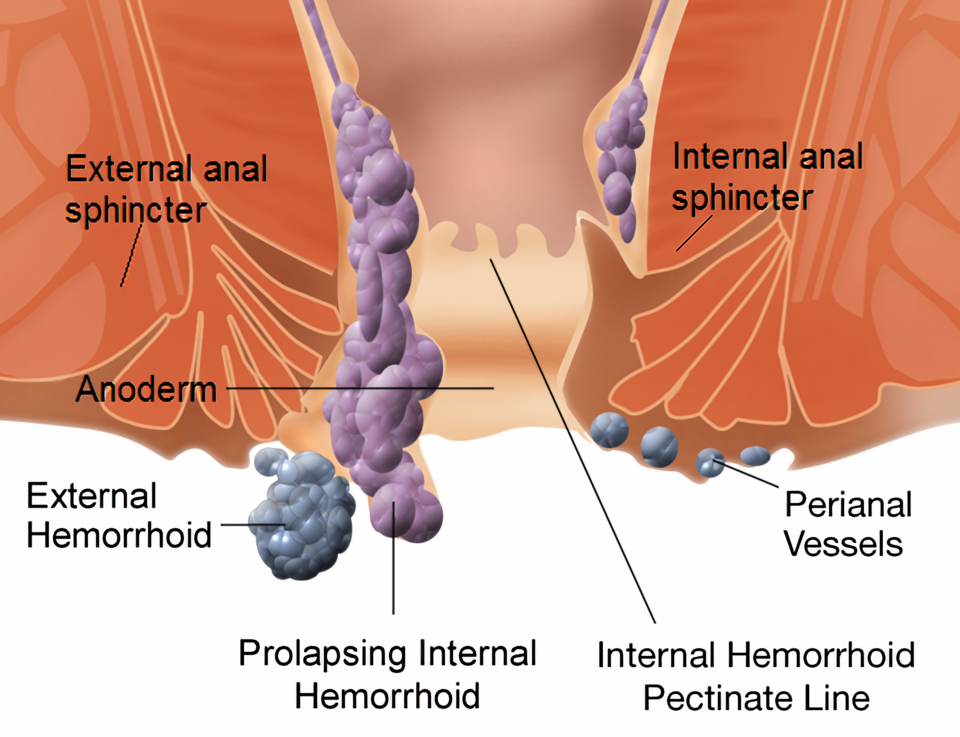 Haemorrhoid